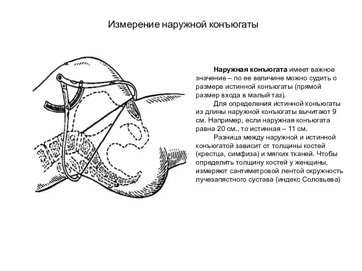 Измерение наружной конъюгаты Наружная конъюгата имеет важное значение – по