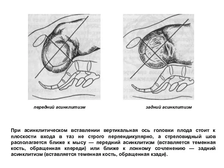 Основные акушерские понятия передний асинклитизм задний асинклитизм При асинклитическом вставлении