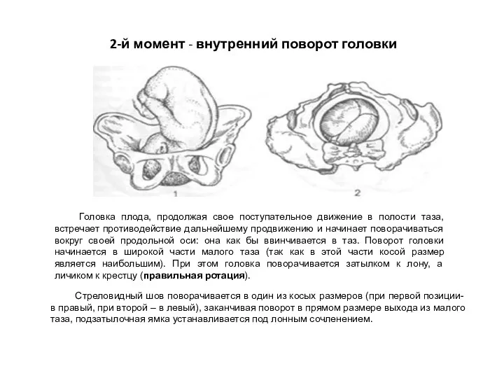 2-й момент - внутренний поворот головки Головка плода, продолжая свое