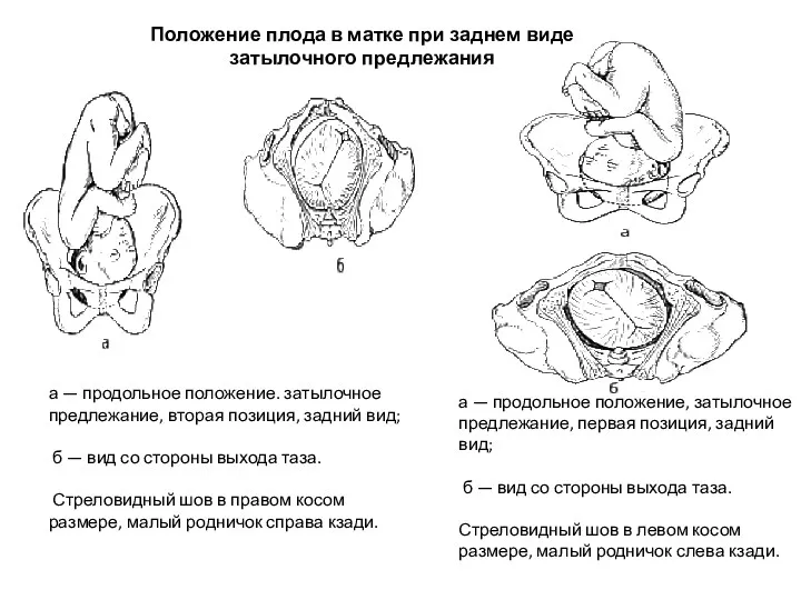 Положение плода в матке при заднем виде затылочного предлежания а