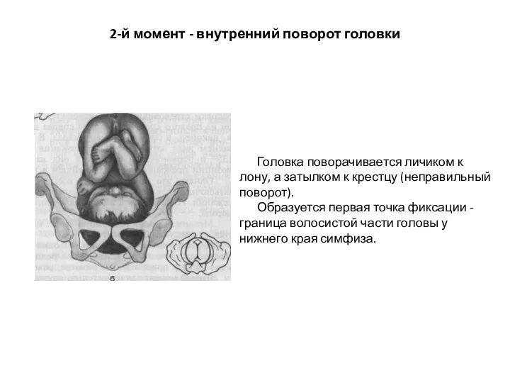 2-й момент - внутренний поворот головки Головка поворачивается личиком к