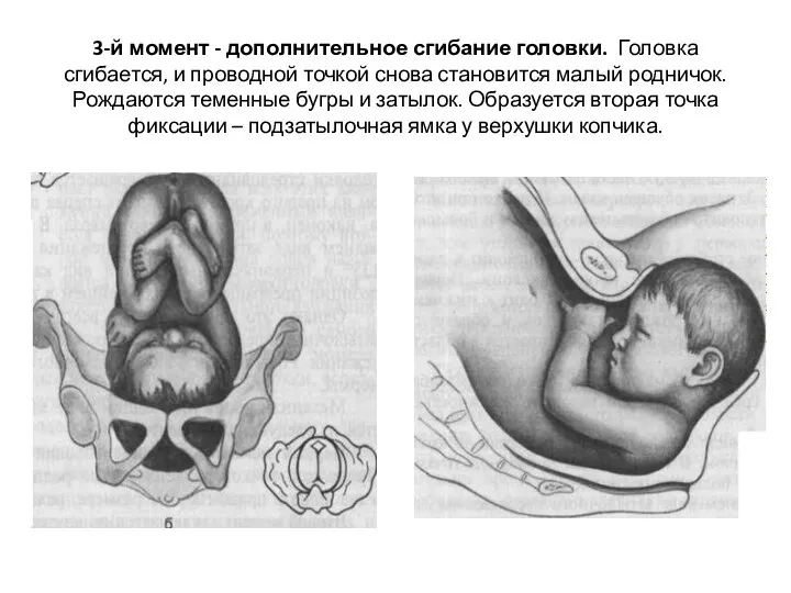 3-й момент - дополнительное сгибание головки. Головка сгибается, и проводной