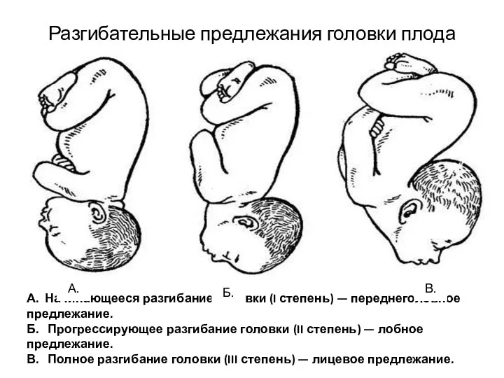 Разгибательные предлежания головки плода А. Начинающееся разгибание головки (I степень)