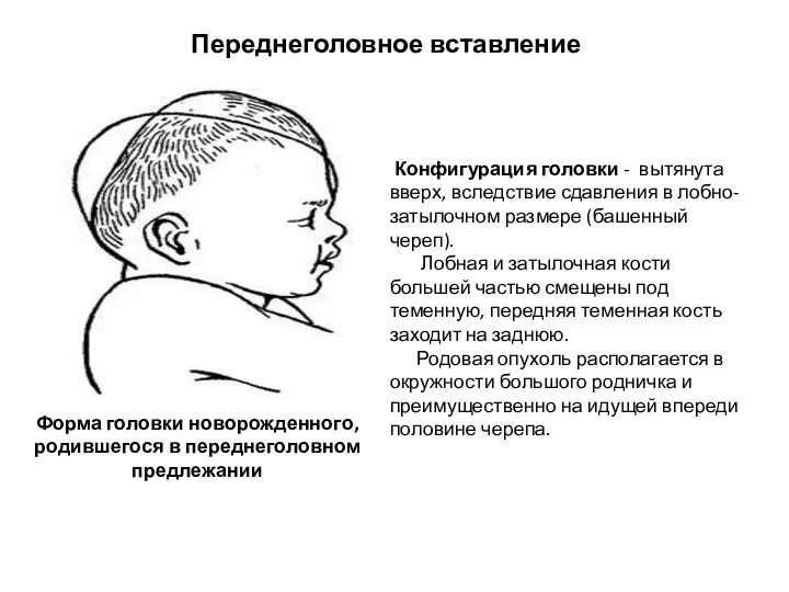 Переднеголовное вставление Форма головки новорожденного, родившегося в переднеголовном предлежании Конфигурация