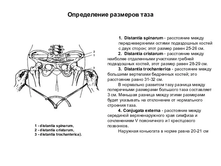 Определение размеров таза 1 - distantia spinarum, 2 - distantia