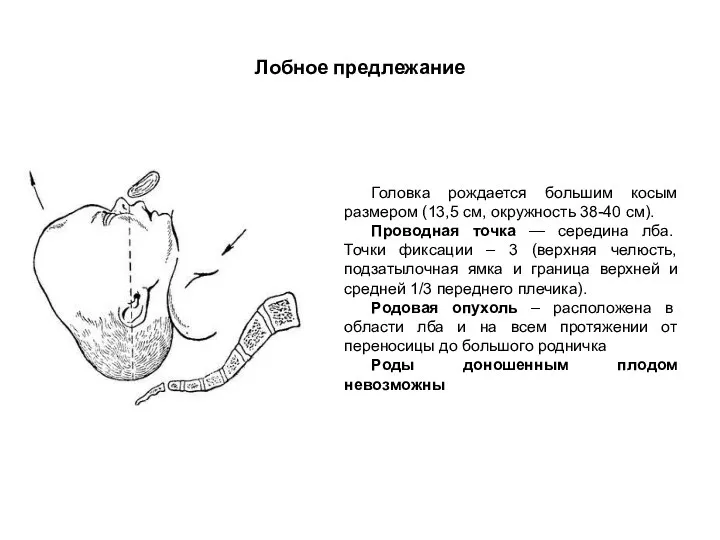 Лобное предлежание Головка рождается большим косым размером (13,5 см, окружность