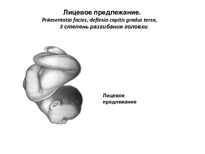 Лицевое предлежание. Prаesentatio facies, deflexio capitis gradus tersa, 3 степень разгибания головки. Лицевое предлежание