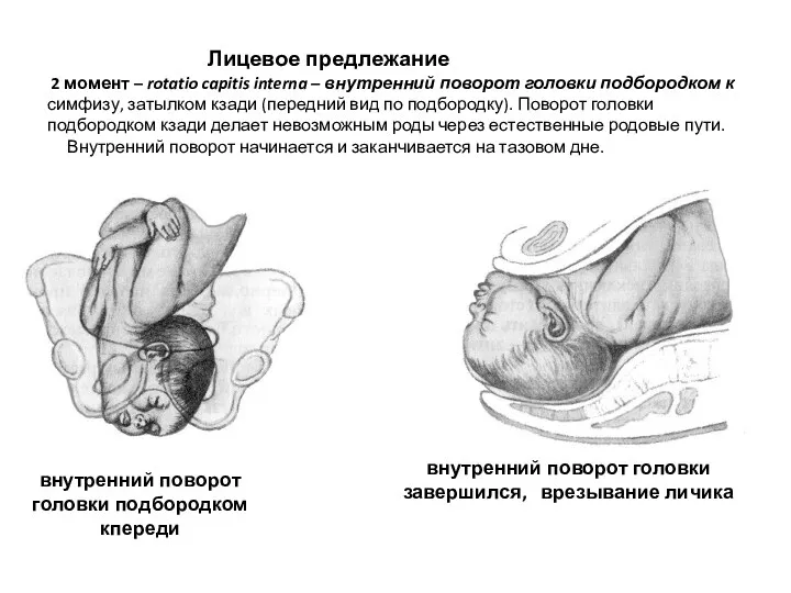 Лицевое предлежание 2 момент – rotatio capitis interna – внутренний