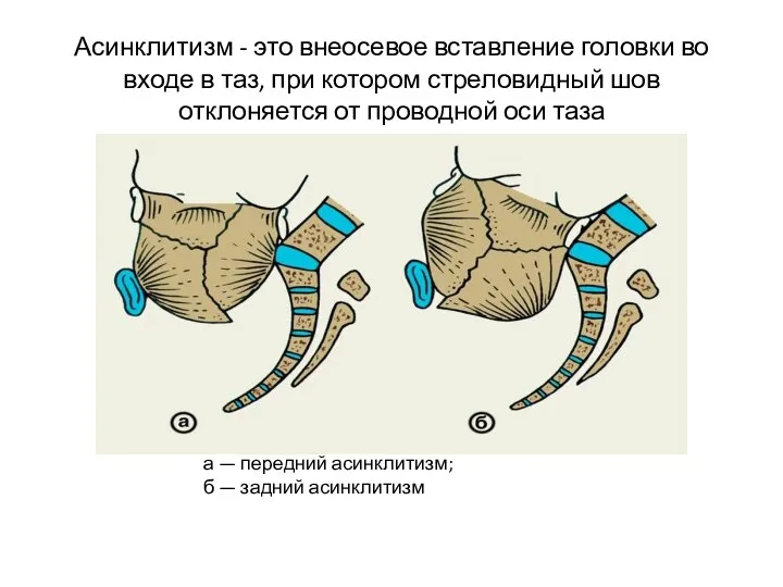 Асинклитизм - это внеосевое вставление головки во входе в таз,