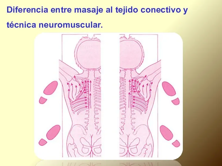 Diferencia entre masaje al tejido conectivo y técnica neuromuscular.