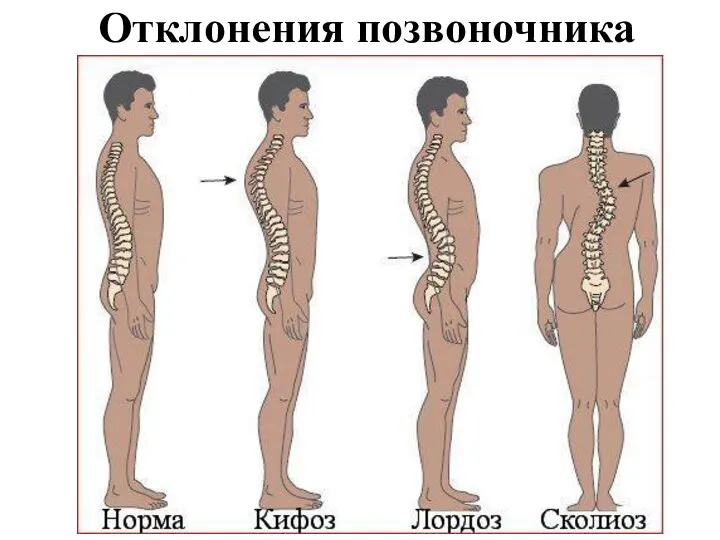 Отклонения позвоночника