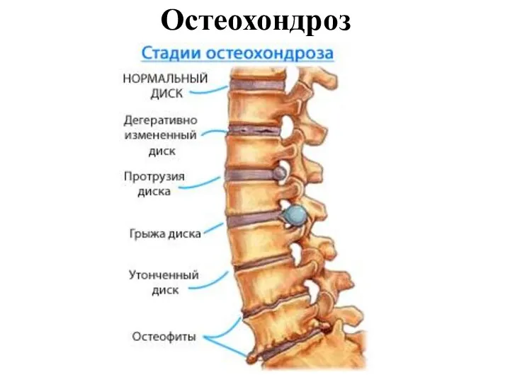 Остеохондроз