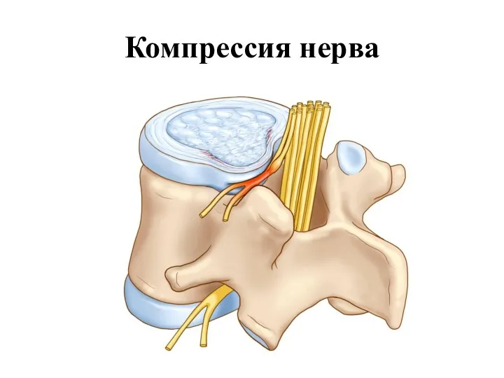 Компрессия нерва