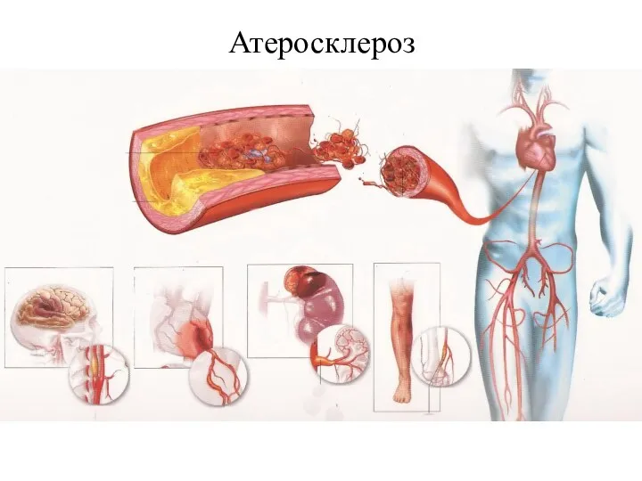 Атеросклероз