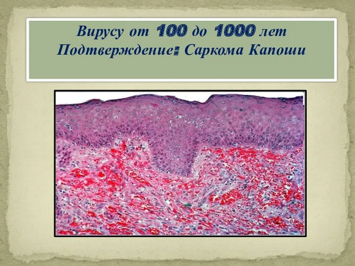 Вирусу от 100 до 1000 лет Подтверждение: Саркома Капоши