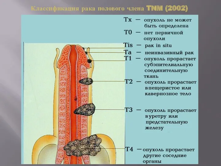 Классификация рака полового члена TNM (2002)