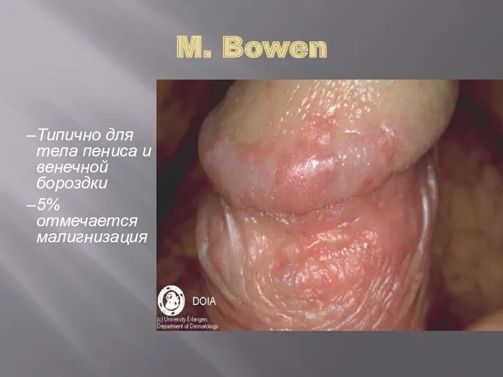 M. Bowen Типично для тела пениса и венечной бороздки 5% отмечается малигнизация