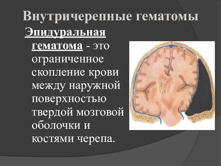 Внутричерепные гематомы Эпидуральная гематома - это ограниченное скопление крови между