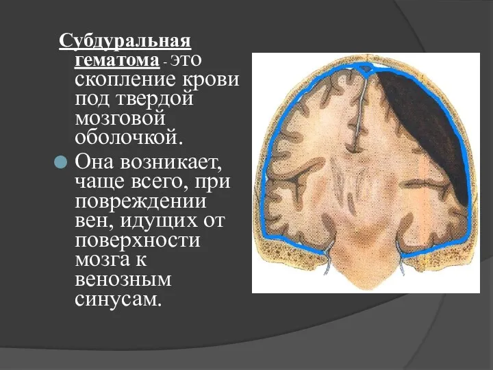 Субдуральная гематома - это скопление крови под твердой мозговой оболочкой.