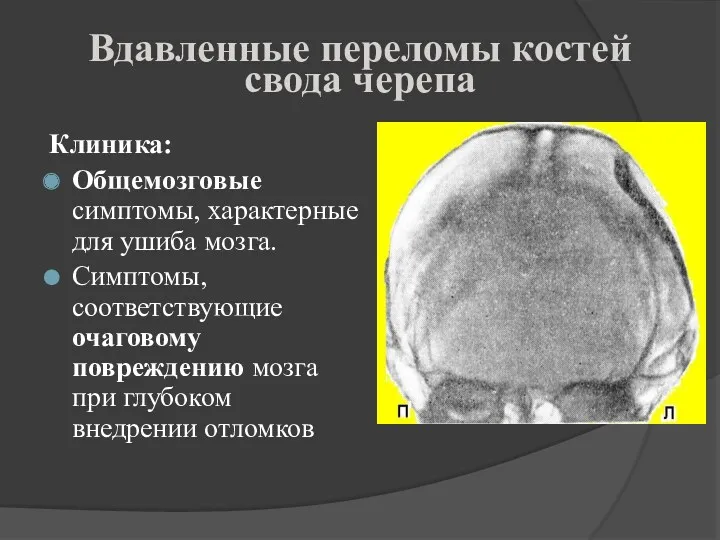 Вдавленные переломы костей свода черепа Клиника: Общемозговые симптомы, характерные для