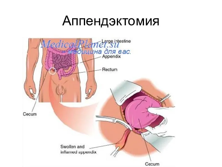 Аппендэктомия