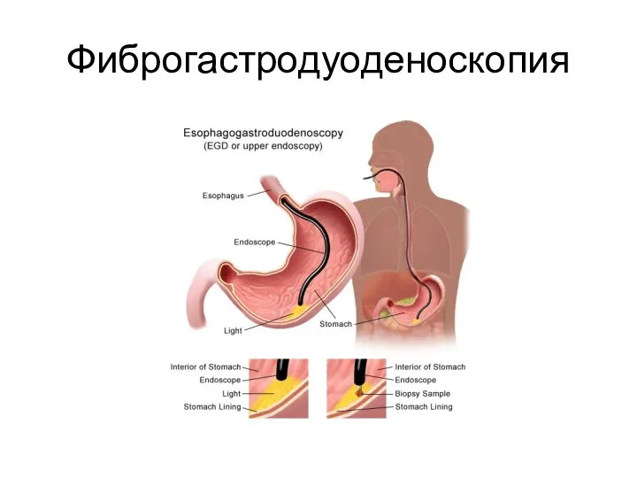 Фиброгастродуоденоскопия