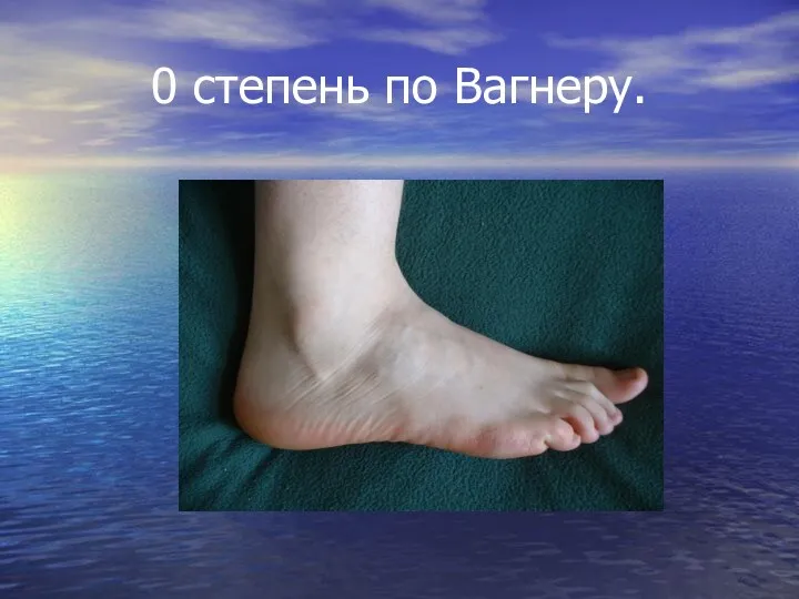 0 степень по Вагнеру.