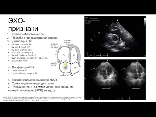 ЭХО-признаки Симптом МакКоннелла Тромбы в правых отделах сердца Дилатация ПЖ: