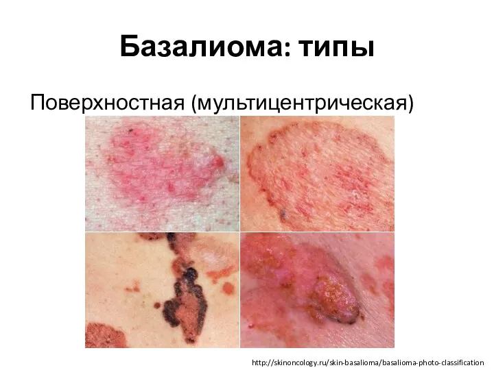 Базалиома: типы Поверхностная (мультицентрическая) http://skinoncology.ru/skin-basalioma/basalioma-photo-classification