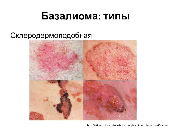 Базалиома: типы Склеродермоподобная http://skinoncology.ru/skin-basalioma/basalioma-photo-classification