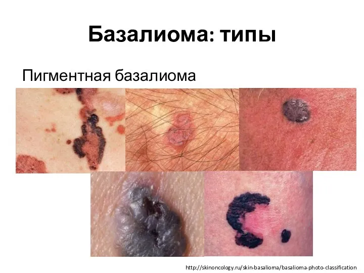 Базалиома: типы Пигментная базалиома http://skinoncology.ru/skin-basalioma/basalioma-photo-classification