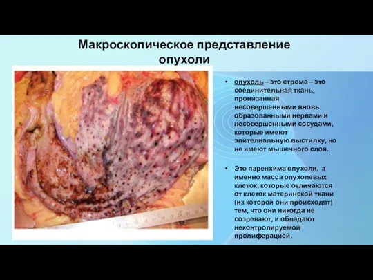 Макроскопическое представление опухоли опухоль – это строма – это соединительная