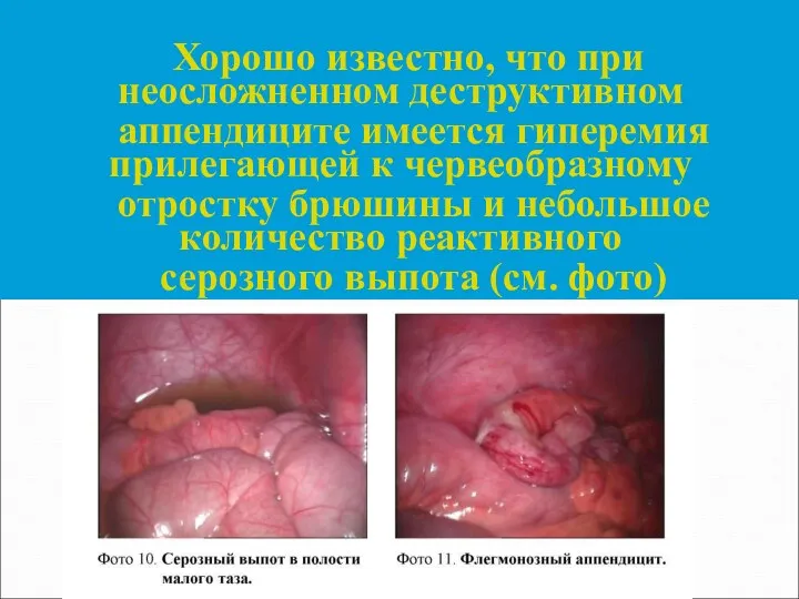 Хорошо известно, что при неосложненном деструктивном аппендиците имеется гиперемия прилегающей