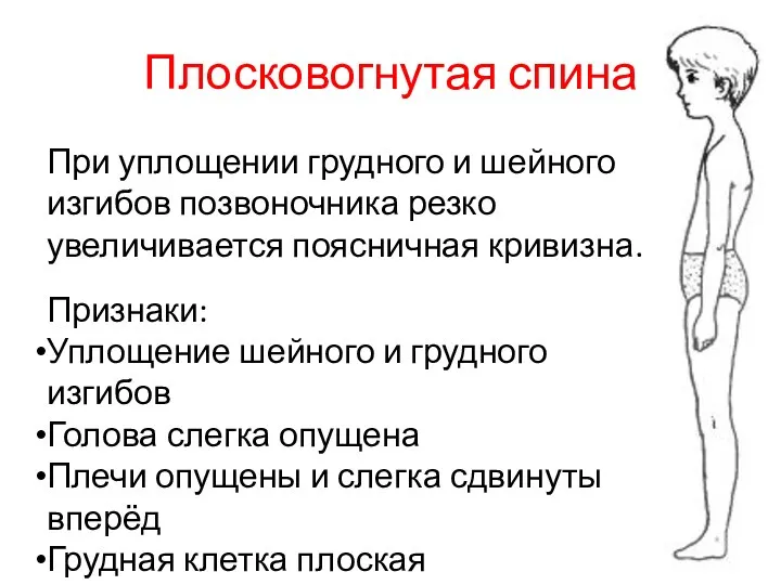 Плосковогнутая спина При уплощении грудного и шейного изгибов позвоночника резко