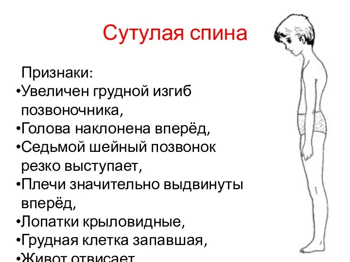 Сутулая спина Признаки: Увеличен грудной изгиб позвоночника, Голова наклонена вперёд,