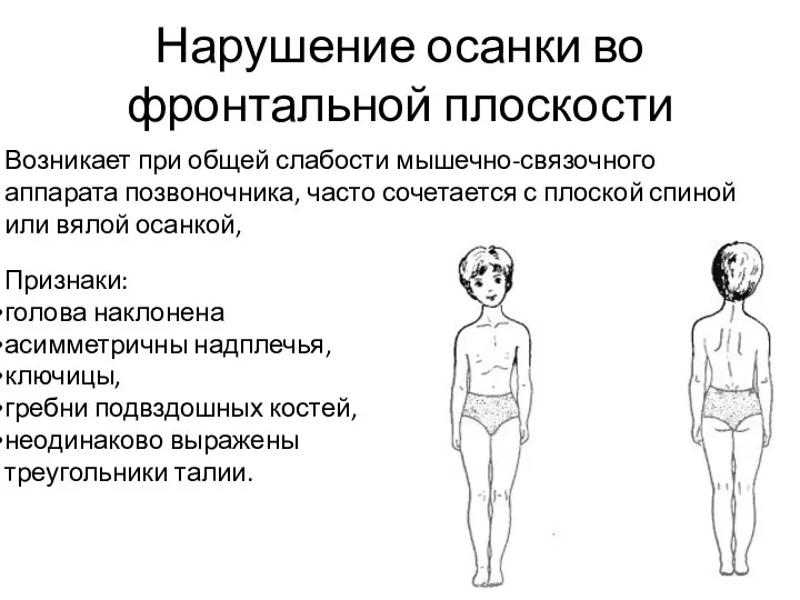 Нарушение осанки во фронтальной плоскости Возникает при общей слабости мышечно-связочного