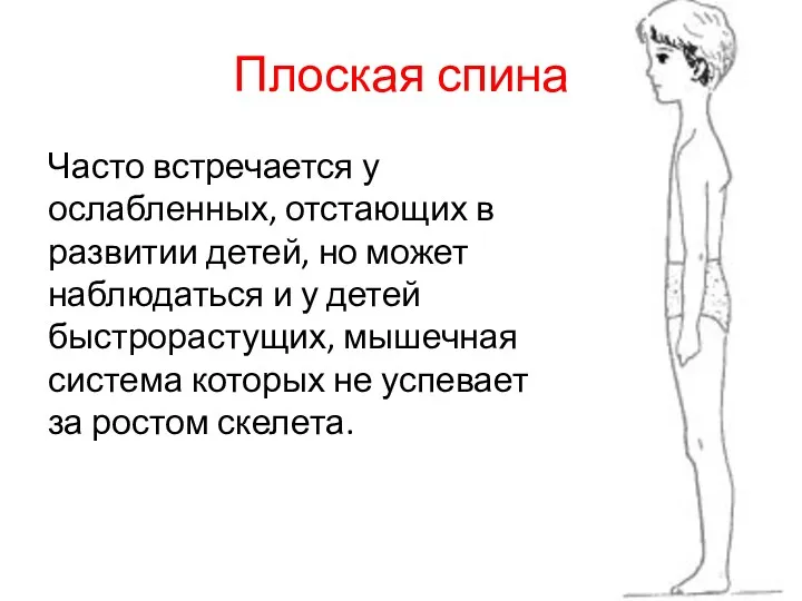 Плоская спина Часто встречается у ослабленных, отстающих в развитии детей,