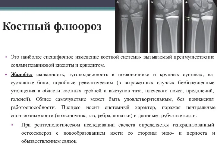 Костный флюороз Это наиболее специфичное изменение костной системы- вызываемый преимущественно