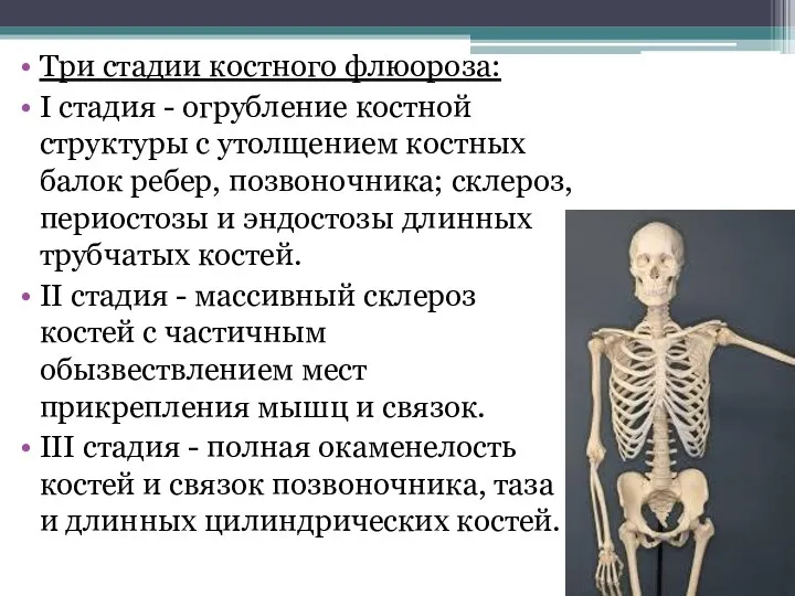 Три стадии костного флюороза: I стадия - огрубление костной структуры