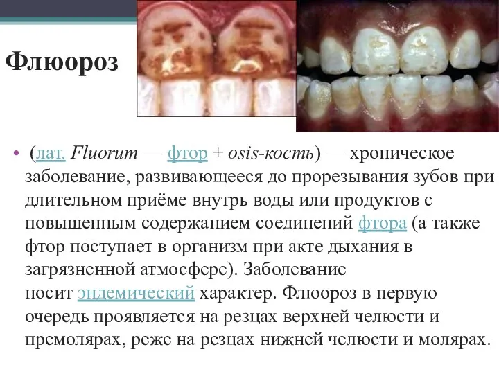 Флюороз (лат. Fluorum — фтор + osis-кость) — хроническое заболевание,