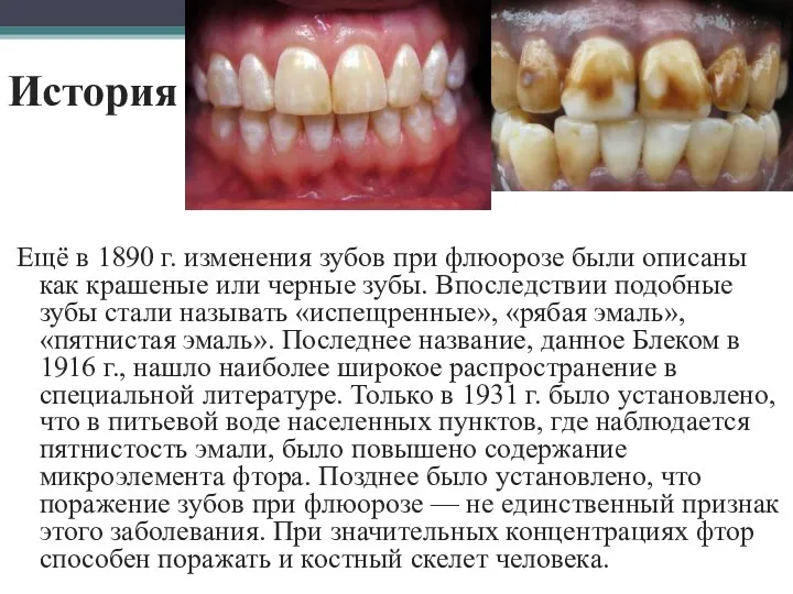 История Ещё в 1890 г. изменения зубов при флюорозе были