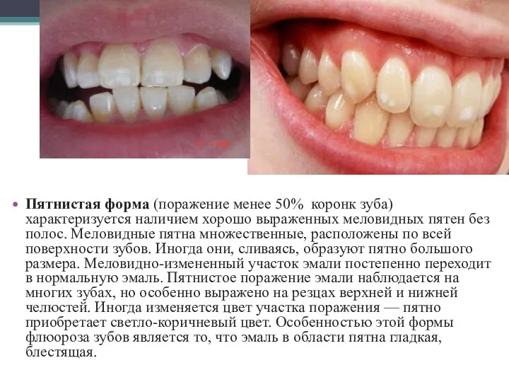 Пятнистая форма (поражение менее 50% коронк зуба) характеризуется наличием хорошо