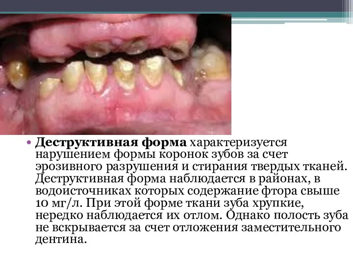 Деструктивная форма характеризуется нарушением формы коронок зубов за счет эрозивного