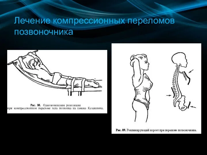 Лечение компрессионных переломов позвоночника