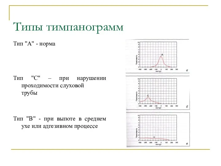 Типы тимпанограмм Тип "А" - норма Тип "С" – при