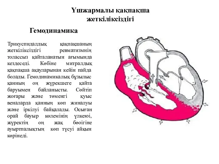 Үшжармалы қақпақша жеткіліксіздігі Трикуспидалдық қақпақшаның жеткіліксіздігі ревматизмнің толассыз қайталанатын ағымында