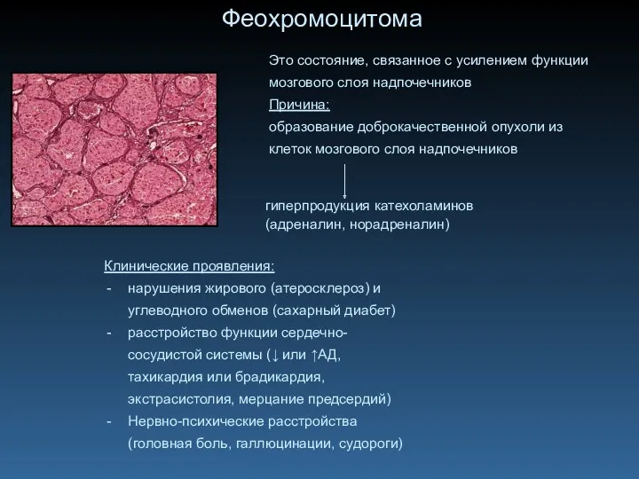Феохромоцитома Это состояние, связанное с усилением функции мозгового слоя надпочечников