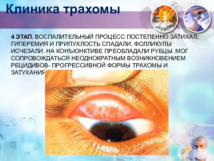 4 ЭТАП. ВОСПАЛИТЕЛЬНЫЙ ПРОЦЕСС ПОСТЕПЕННО ЗАТИХАЛ, ГИПЕРЕМИЯ И ПРИПУХЛОСТЬ СПАДАЛИ,