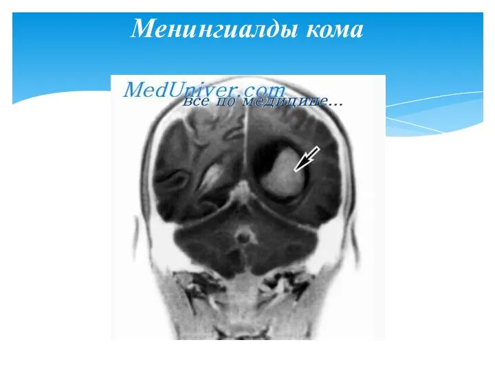 Менингиалды кома