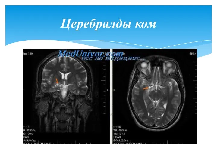 Церебралды ком